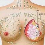 Mastectomía: Cáncer de mama