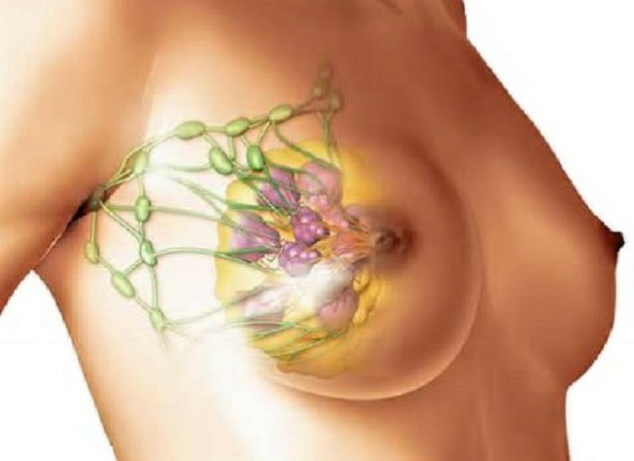симптомы воспаления груди у женщин фото 34